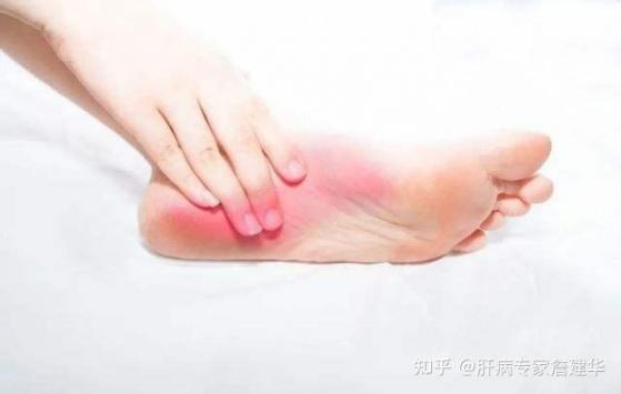 肝不好的人看腳就知道，肝不好的人看腳就知道不好