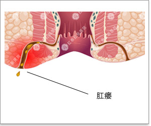 肛瘺前期小疙瘩圖片（肛瘺初期癥狀圖片）