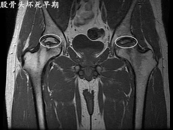 股骨頸骨折后股骨頭壞死早期癥狀（股骨頭壞死早期癥狀）