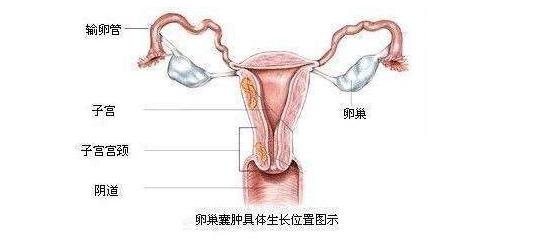 卵巢囊腫的10個征兆卵巢在左邊還是在右邊（卵巢囊腫的10個征兆）