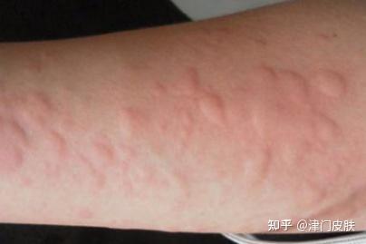 各類疹子識別圖（各種皮膚病對照圖片）