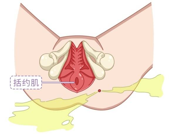 得了肛瘺是馬上手術還是保守治療（肛瘺為何不建議手術）