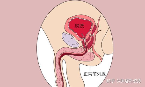 早期前列腺癌身體七大癥狀（早期前列腺癌8個征兆）