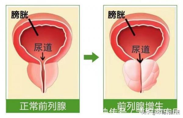 前列腺增生怎么治療最好的方法孫大興y簡介（前列腺增生怎么治療最好的方法）