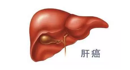肝癌病人要走前的征兆清腸（肝癌病人要走前的征兆）