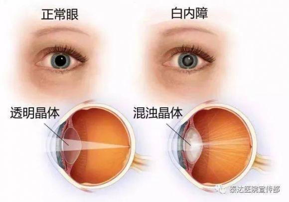 白內障的癥狀和表現與老花眼區別（白內障的癥狀）
