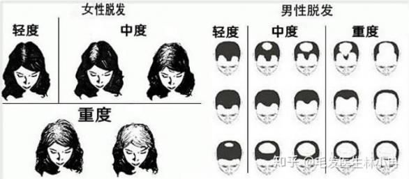 脂溢性脫發如何自救（脂溢性脫發能長回來嗎）