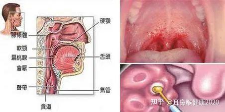 急性咽炎一般幾天恢復（怎么區分是咽炎還是扁桃體炎）
