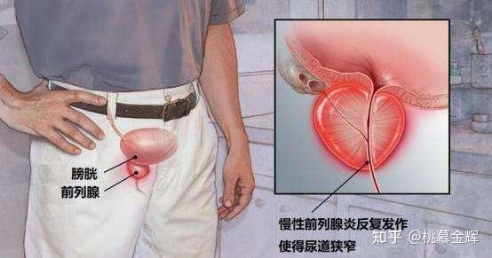 有前列腺炎能過夫妻生活嗎（前列腺炎拖久了會怎么樣）