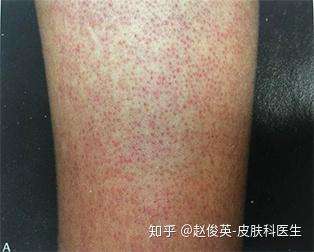 維生素a軟膠囊雞皮膚（口服維生素a雞皮膚好了）