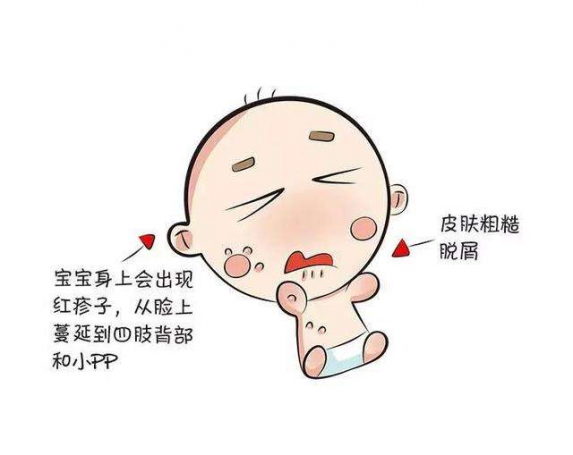 過敏性紅疹子圖片小孩（過敏性紅疹子圖片）