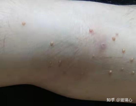 hpv男性感染后的表現會長在眼皮上嗎（hpv男性感染后的表現）