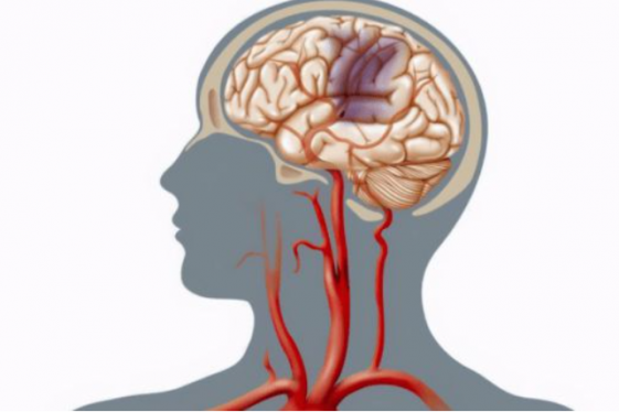 女性大腦供血不足的癥狀有哪些（腦供血不足的癥狀有哪些）