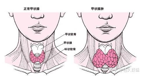 乳腺結節（甲狀腺結節是什么原因造成的）