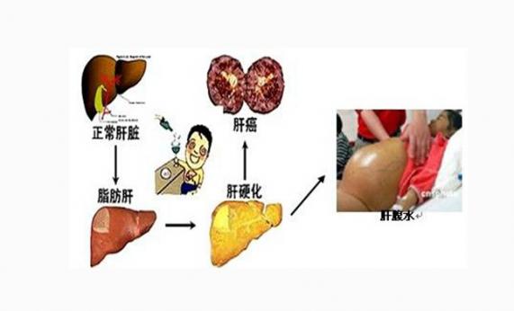 乙肝早期會有什么癥狀（乙肝早期可能有6個征兆）