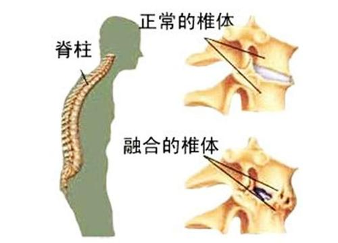 強直性脊柱炎的病癥是什么樣女怎樣好的快不疼（強直性脊柱炎的病癥是什么樣）