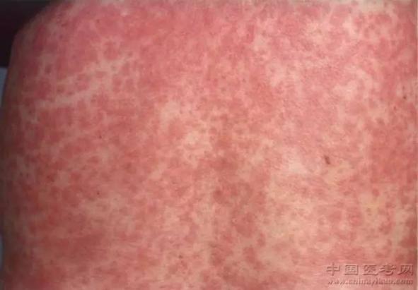 皮膚病圖片對照大全查看圖片（皮膚病圖片對照大全查看圖片皮膚過敏）