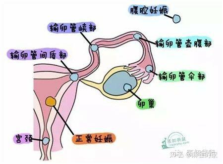宮外懷孕是怎么形成的（宮外懷孕多少天才知道）