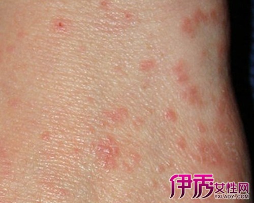 疥瘡的最快治療方法（疥瘡最有效的藥膏）
