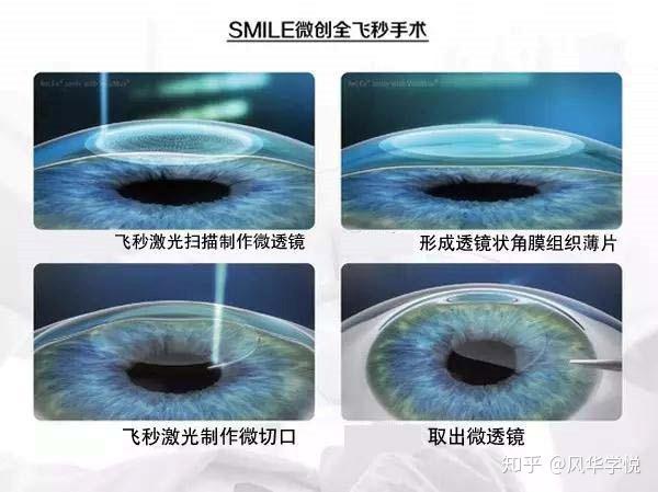 眼睛激光手術大概需要多少錢（眼睛激光手術大概需要多少錢一次）