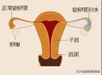 怎么判斷自己得了盆腔炎（盆腔炎用什么藥效果最好）