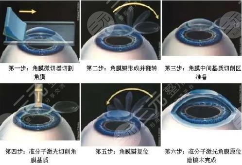 眼睛手術費用一覽表（眼睛手術費用一覽表北京同仁眼科醫院地址）