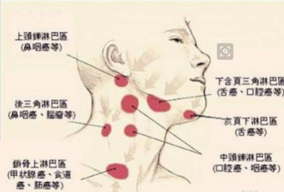 淋巴結腫大有什么癥狀（鎖骨淋巴結腫大有什么癥狀）