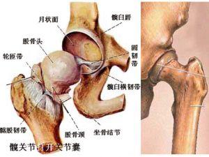 股骨頭壞死的癥狀有哪些（股骨頭壞死的癥狀有哪些）