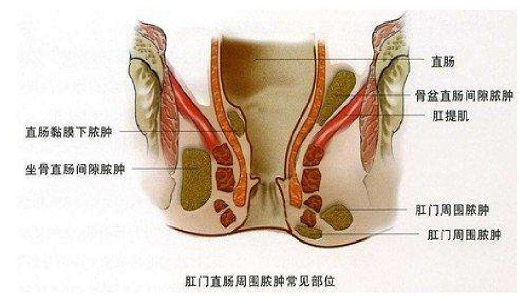 肛瘺啥癥狀怎么治療（肛瘺的癥狀及治療）
