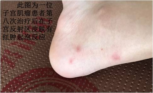 濕疹不治療會自愈嗎（濕疹的圖片和癥狀圖片）