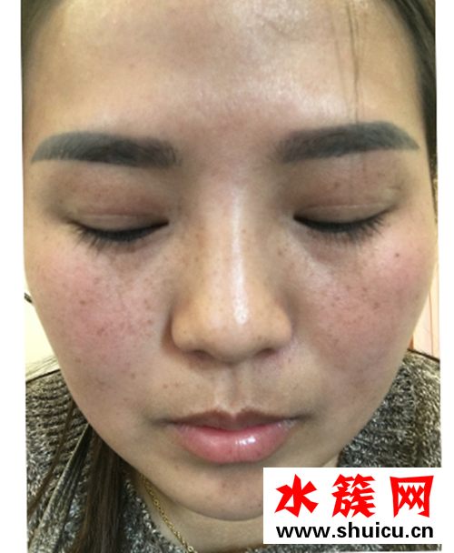 怎樣祛斑？激光祛斑后悔死了