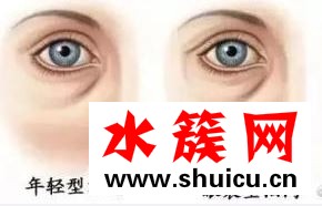 去眼袋多久恢復