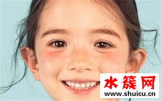 夏天曬斑怎么去除 夏天曬斑到冬天會沒嗎